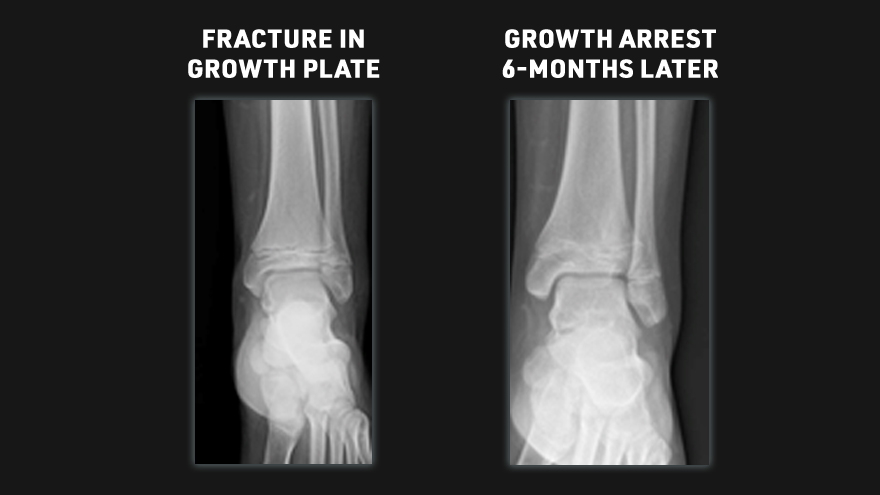 Fracture growth plate x-ray