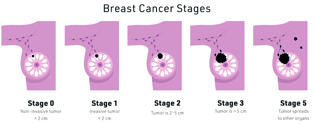 Breast cancer stages
